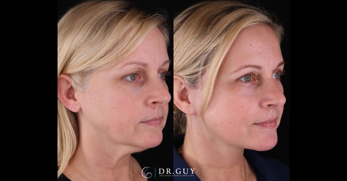 Facelift Before & After Gallery - Patient 363567 - Image 2