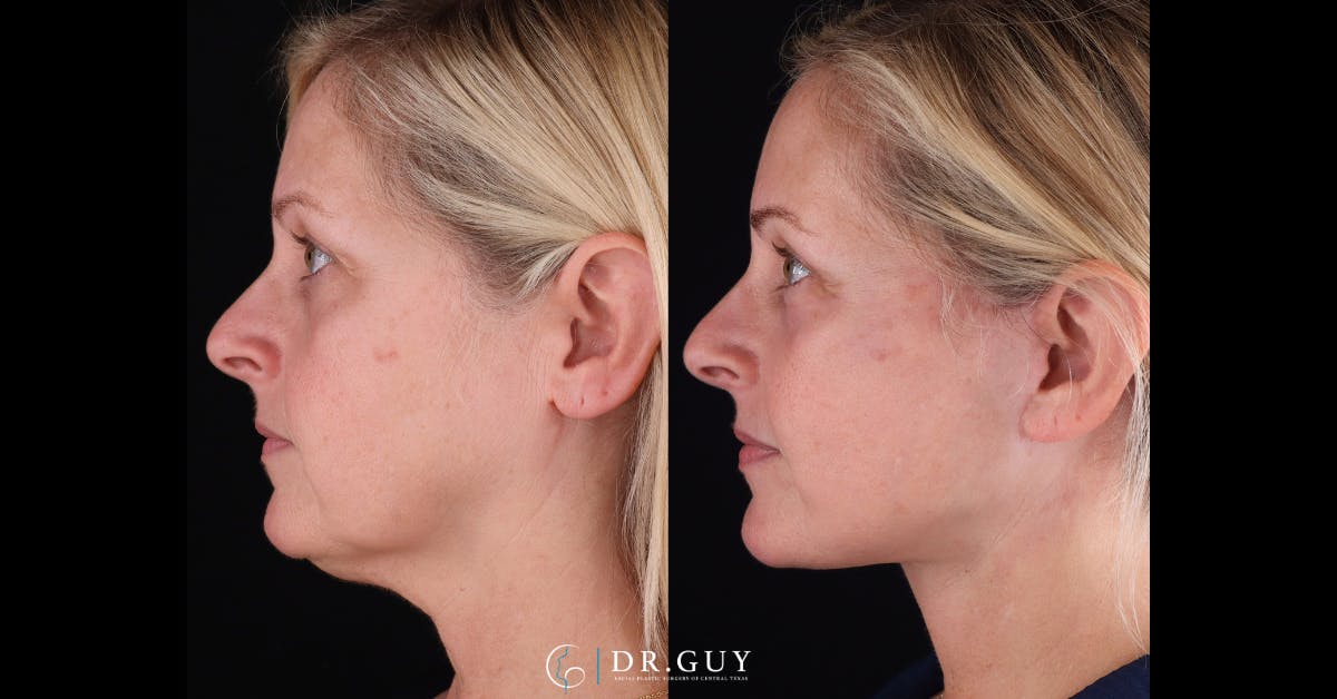 Facelift Before & After Gallery - Patient 363567 - Image 5