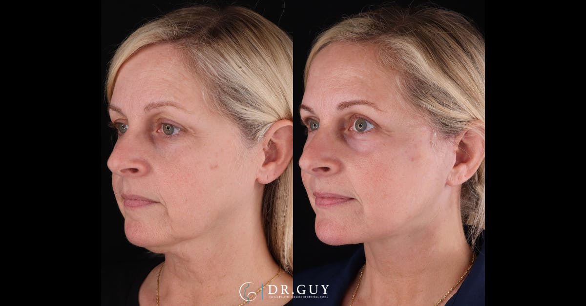 Facelift Before & After Gallery - Patient 363567 - Image 4