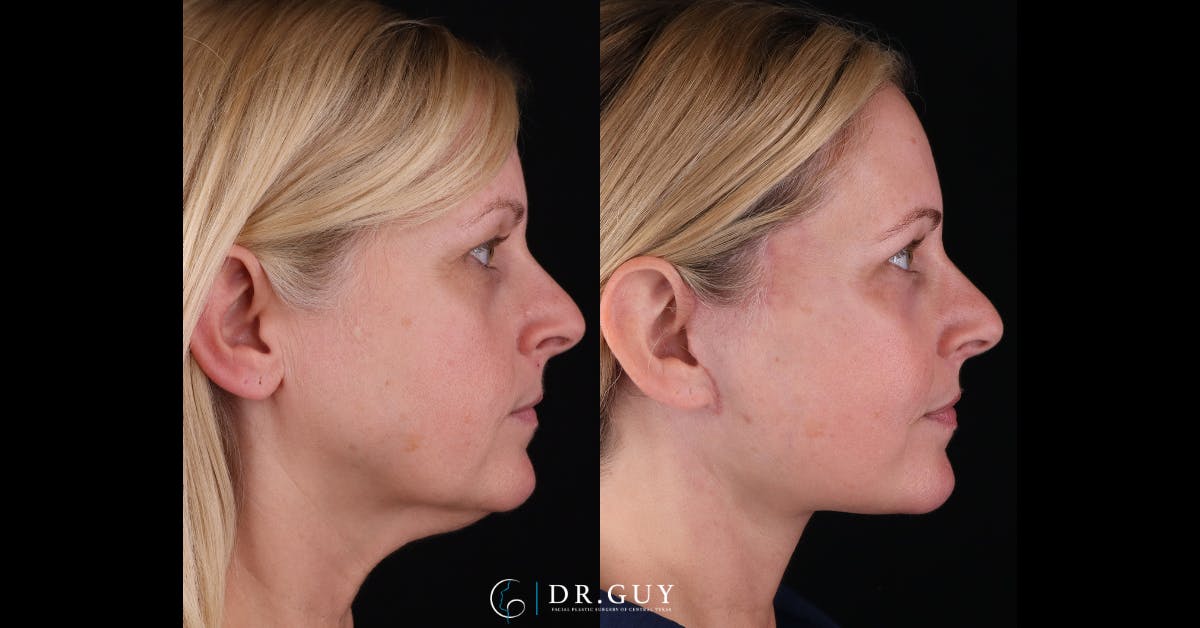 Facelift Before & After Gallery - Patient 363567 - Image 3