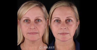 Facelift Before & After Gallery - Patient 363567 - Image 1