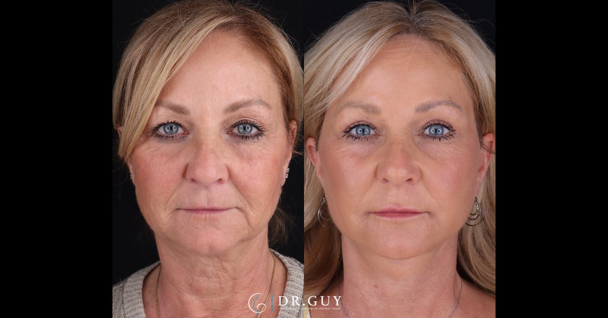 Laser Before & After Gallery - Patient 173941 - Image 1