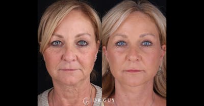 Facelift Before & After Gallery - Patient 188403 - Image 1