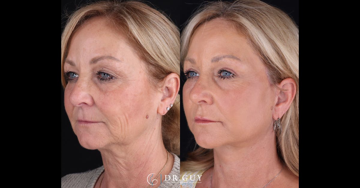 Laser Before & After Gallery - Patient 173941 - Image 2
