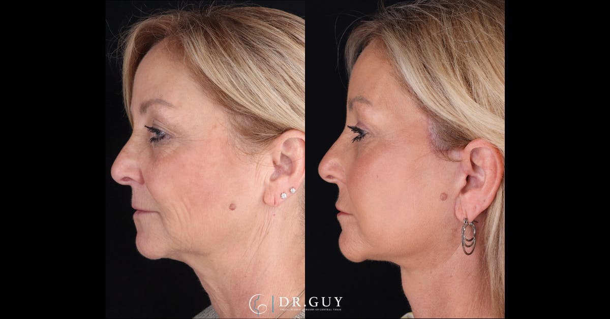Laser Before & After Gallery - Patient 173941 - Image 3