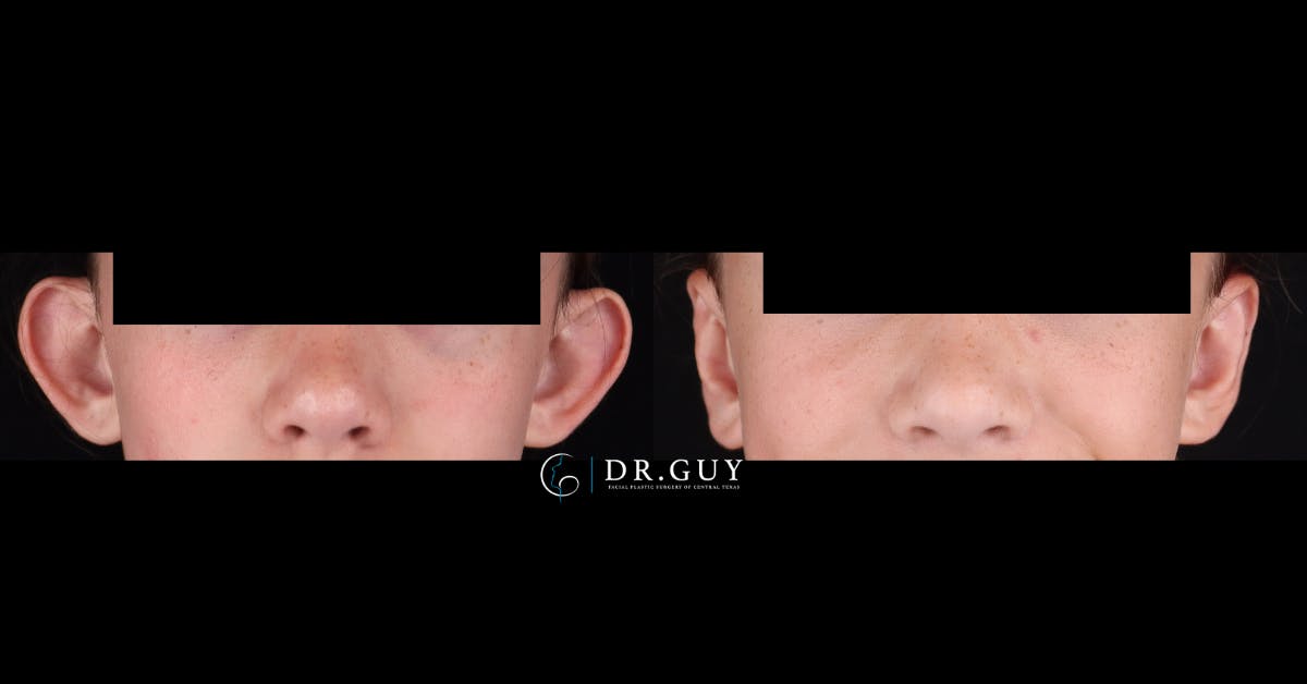 Otoplasty Before & After Gallery - Patient 269133 - Image 1
