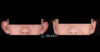 Otoplasty Before & After Gallery - Patient 269133 - Image 1