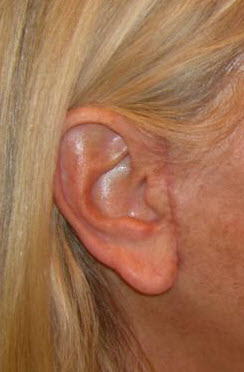 boston-plastic-surgery-bad-scar