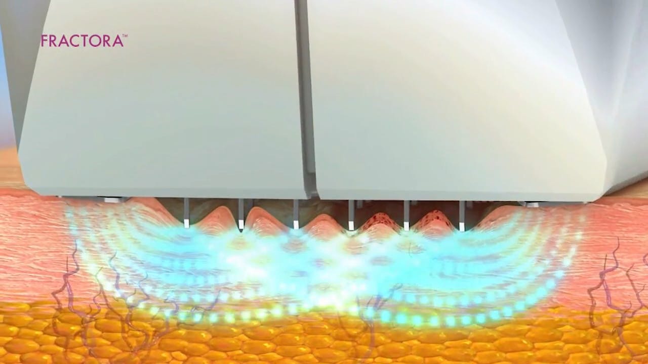 fractora illustration