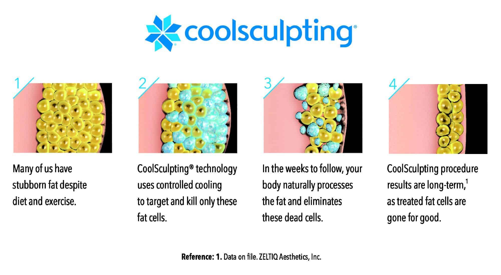 coolsculpting infographic