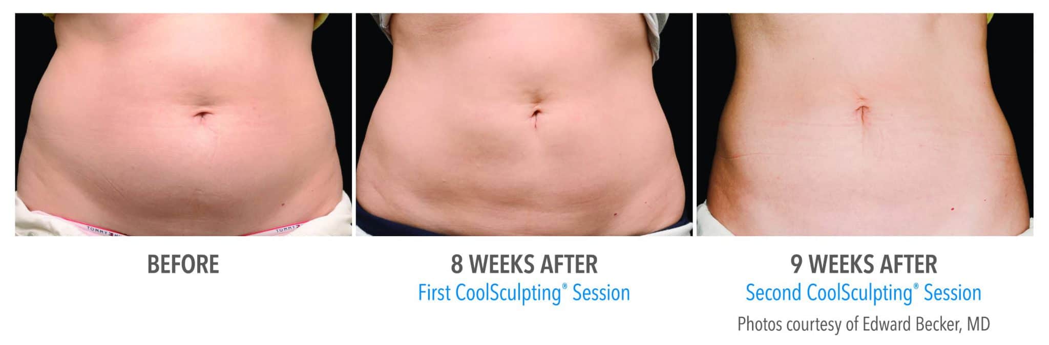 coolsculpting results