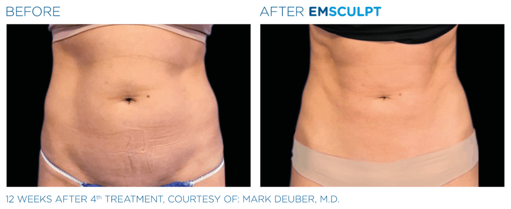 emsculpt results
