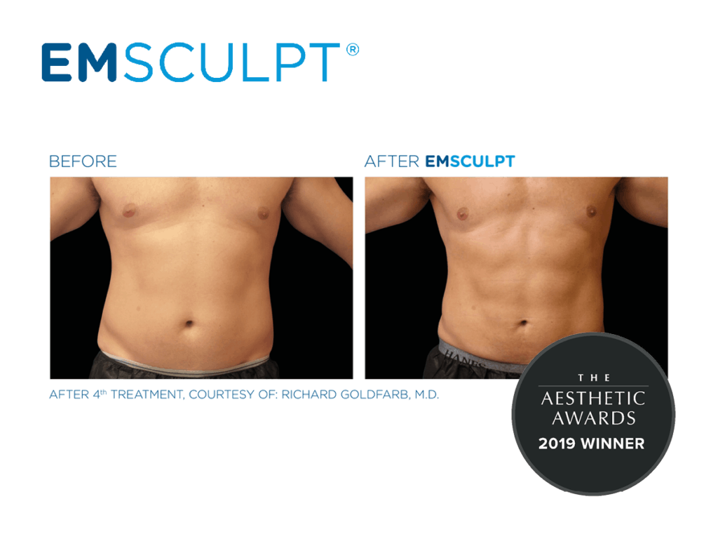 emsculpt results