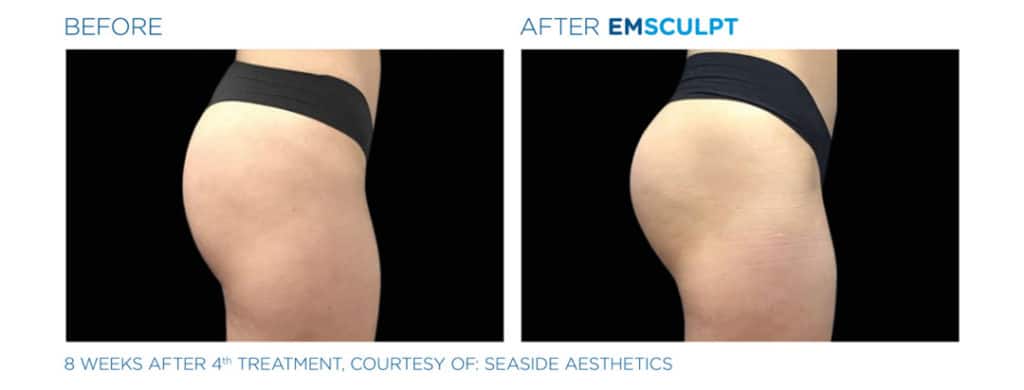 emsculpt results