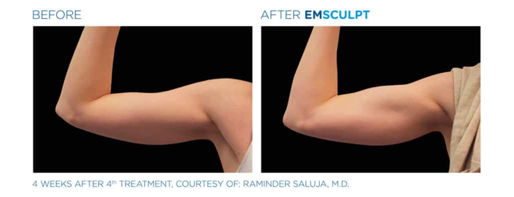 emsculpt results