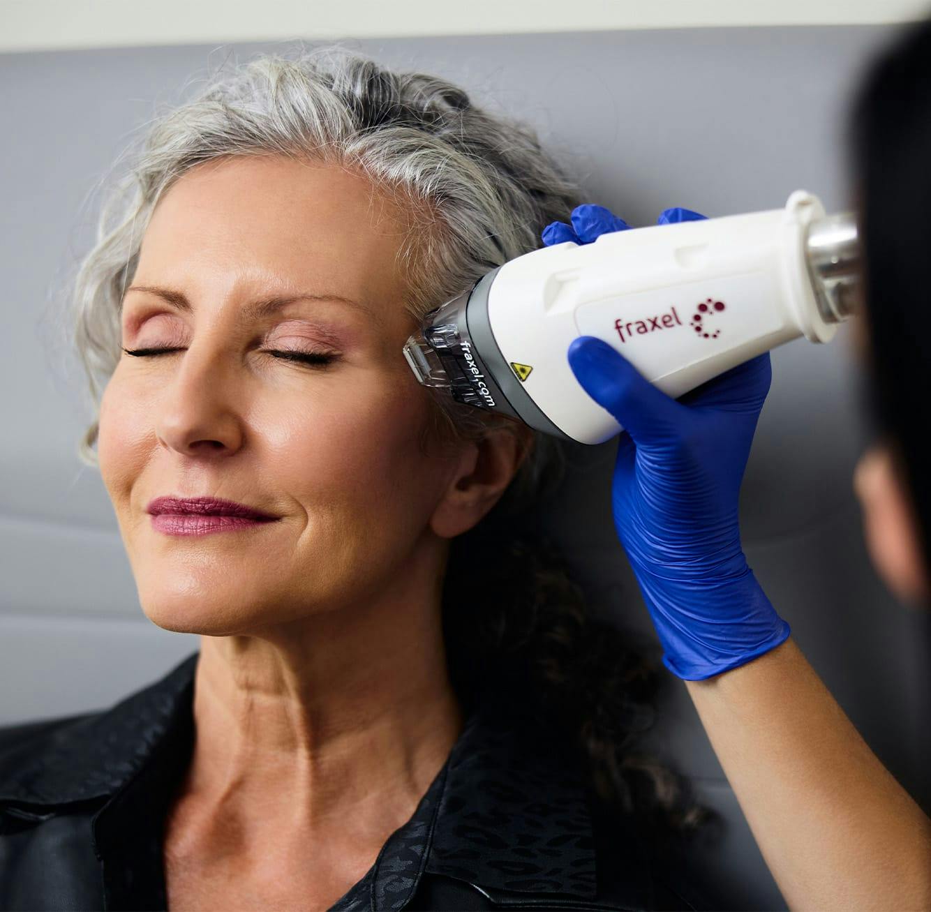 woman getting a Fraxel treatment