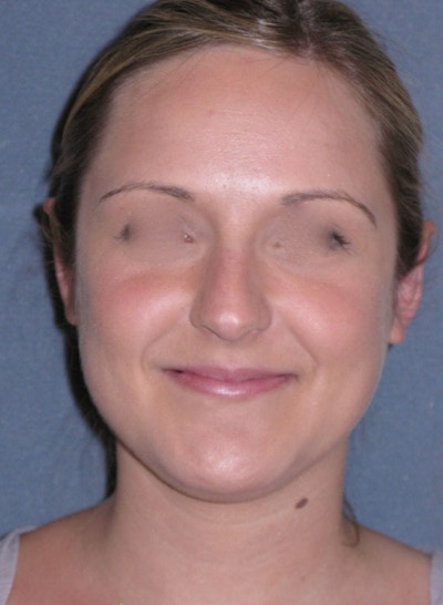 Otoplasty Before & After Gallery - Patient 198467 - Image 2