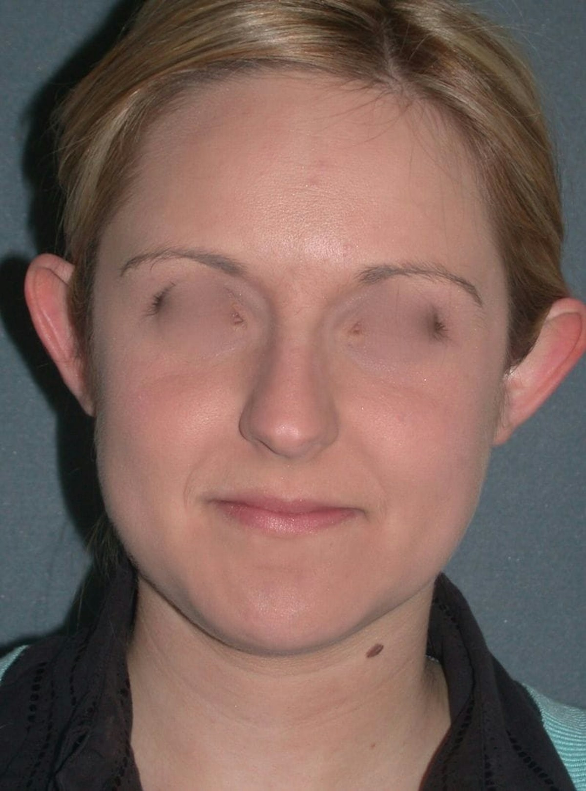 Otoplasty Before & After Gallery - Patient 198467 - Image 1