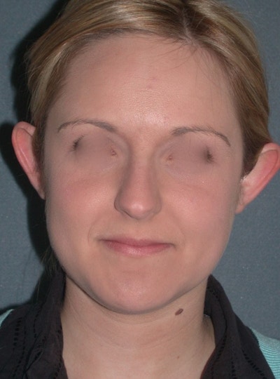 Otoplasty Before & After Gallery - Patient 198467 - Image 1