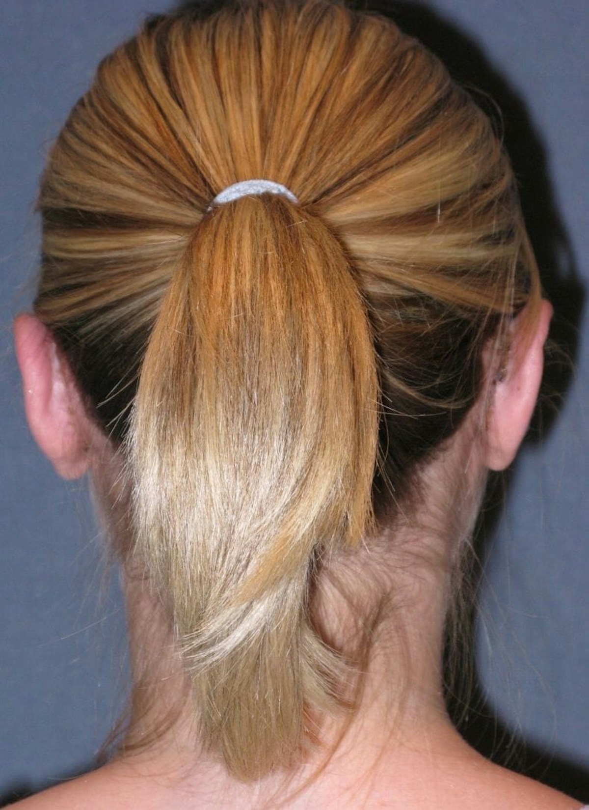 Otoplasty Before & After Gallery - Patient 198467 - Image 4