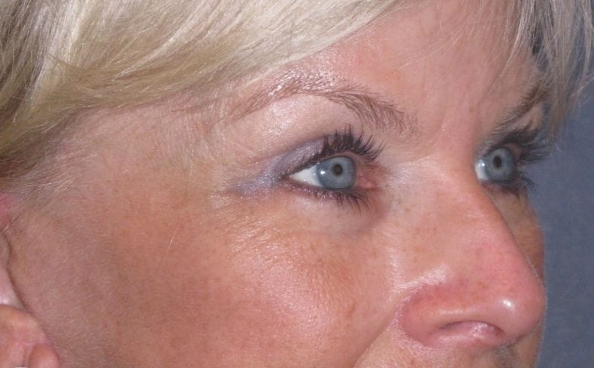 Eyelid Lift- Upper Before & After Gallery - Patient 349234 - Image 4