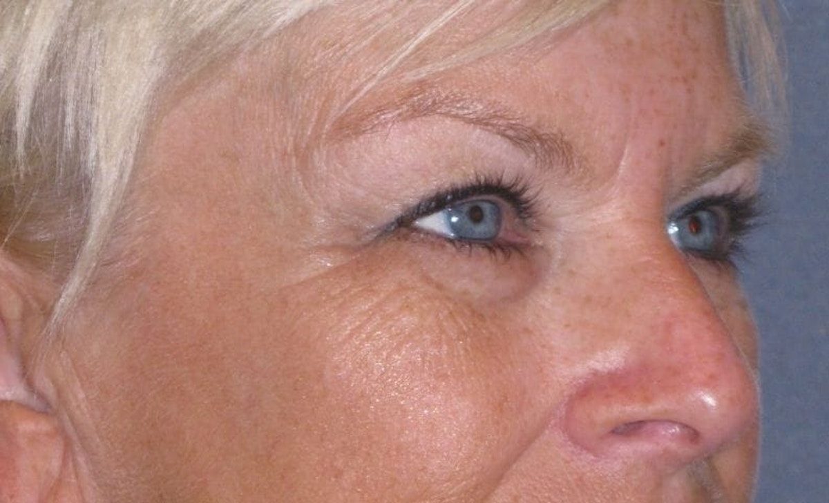 Eyelid Lift- Upper Before & After Gallery - Patient 349234 - Image 3
