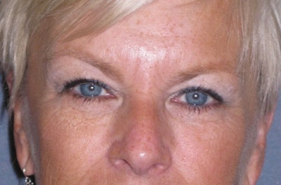 Eyelid Lift- Upper Before & After Gallery - Patient 349234 - Image 1