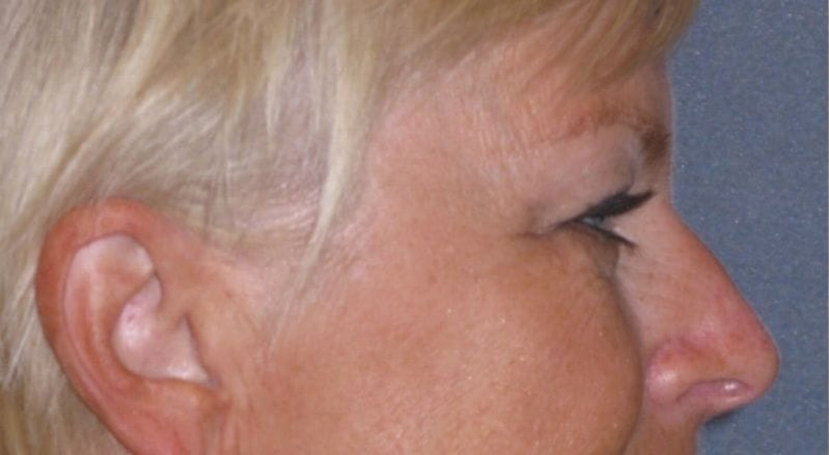 Eyelid Lift- Upper Before & After Gallery - Patient 349234 - Image 5