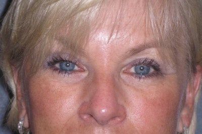 Eyelid Lift- Upper Before & After Gallery - Patient 349234 - Image 2