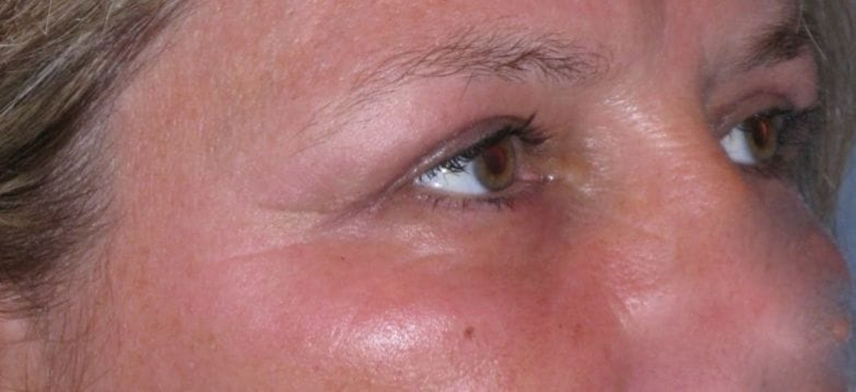 Eyelid Lift- Upper Before & After Gallery - Patient 260712 - Image 4