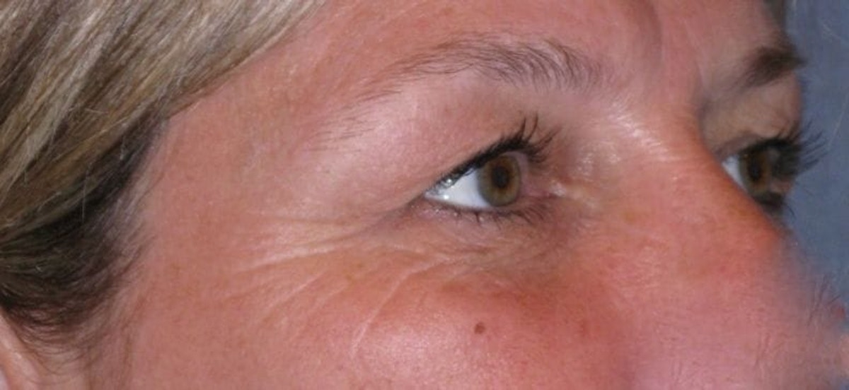 Eyelid Lift- Upper Before & After Gallery - Patient 260712 - Image 3