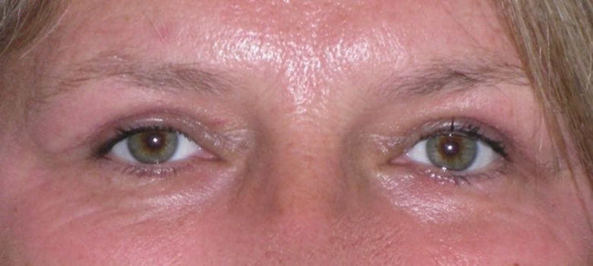 Eyelid Lift- Upper Before & After Gallery - Patient 260712 - Image 2
