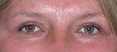 Eyelid Lift- Upper Before & After Gallery - Patient 260712 - Image 2