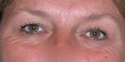 Eyelid Lift- Upper Before & After Gallery - Patient 260712 - Image 1