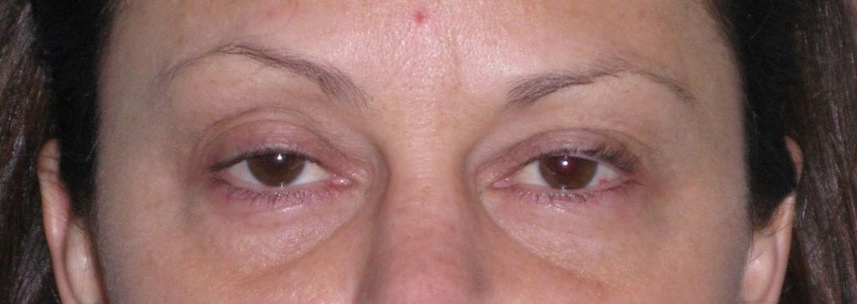 Fat Transfer Before & After Gallery - Patient 542557 - Image 1
