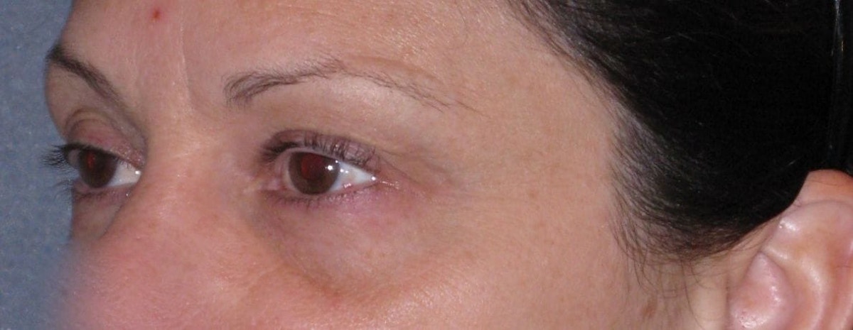 Fat Transfer Before & After Gallery - Patient 542557 - Image 3