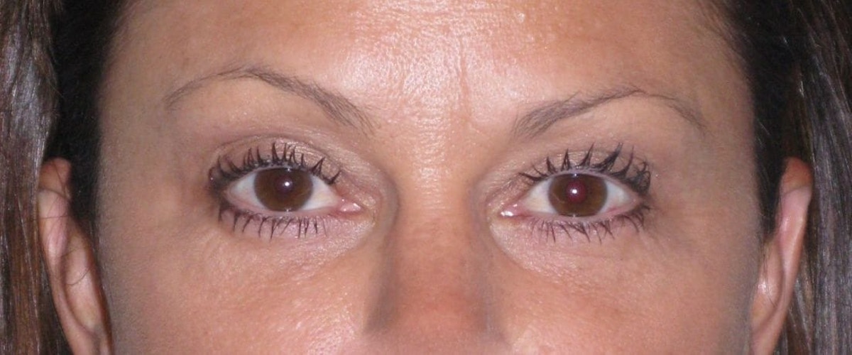 Fat Transfer Before & After Gallery - Patient 542557 - Image 2