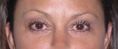 Fat Transfer Before & After Gallery - Patient 542557 - Image 2