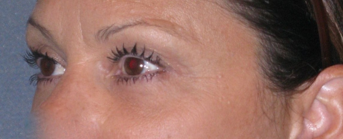 Fat Transfer Before & After Gallery - Patient 542557 - Image 4