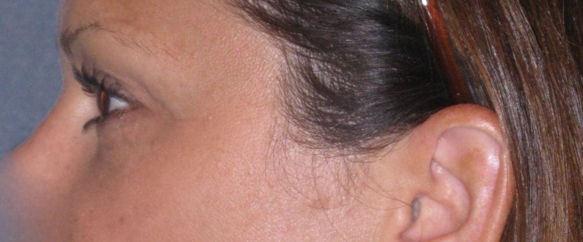 Fat Transfer Before & After Gallery - Patient 542557 - Image 10