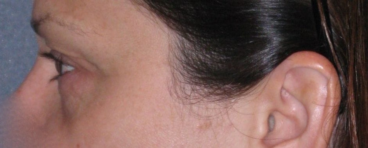 Fat Transfer Before & After Gallery - Patient 542557 - Image 9