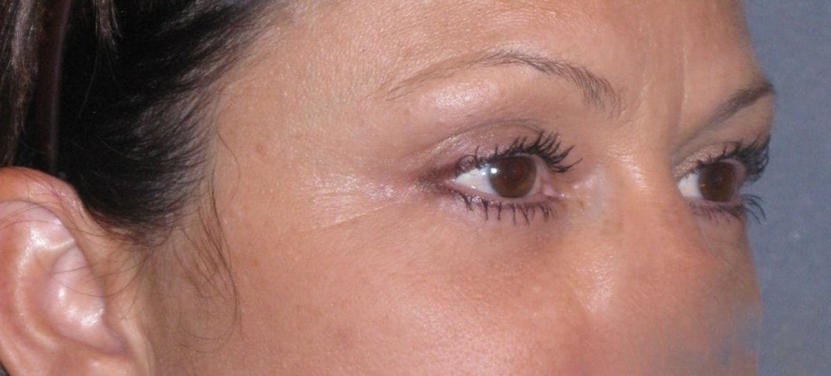 Fat Transfer Before & After Gallery - Patient 542557 - Image 6