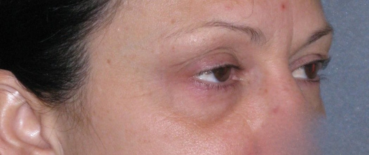 Fat Transfer Before & After Gallery - Patient 542557 - Image 5