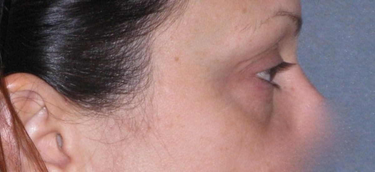 Fat Transfer Before & After Gallery - Patient 542557 - Image 7