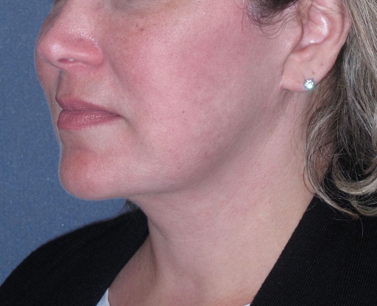 Lower Face & Neck Lifting Before & After Gallery - Patient 299080 - Image 4