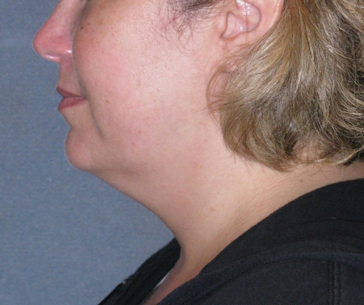 Lower Face & Neck Lifting Before & After Gallery - Patient 299080 - Image 9