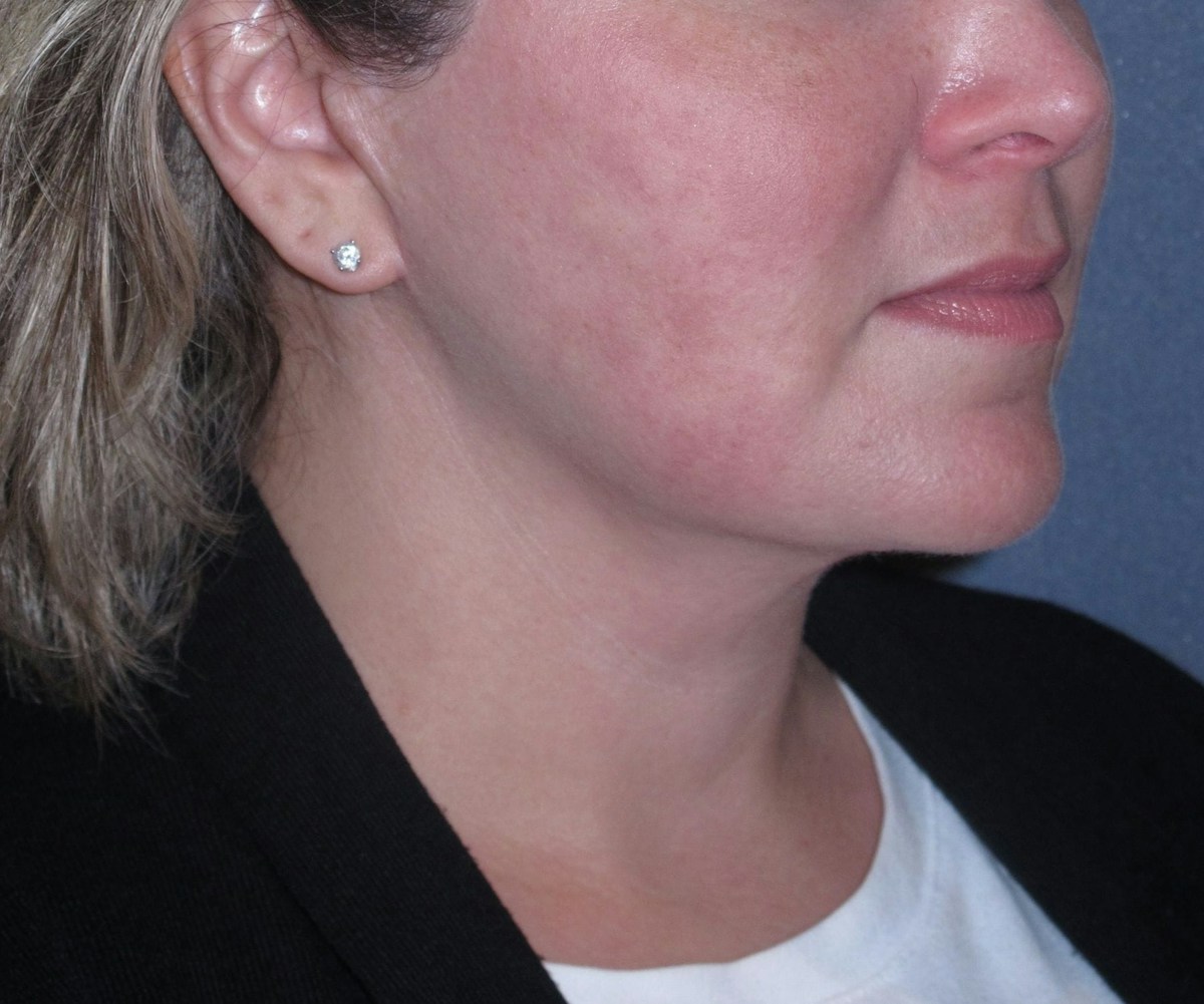 Lower Face & Neck Lifting Before & After Gallery - Patient 299080 - Image 6