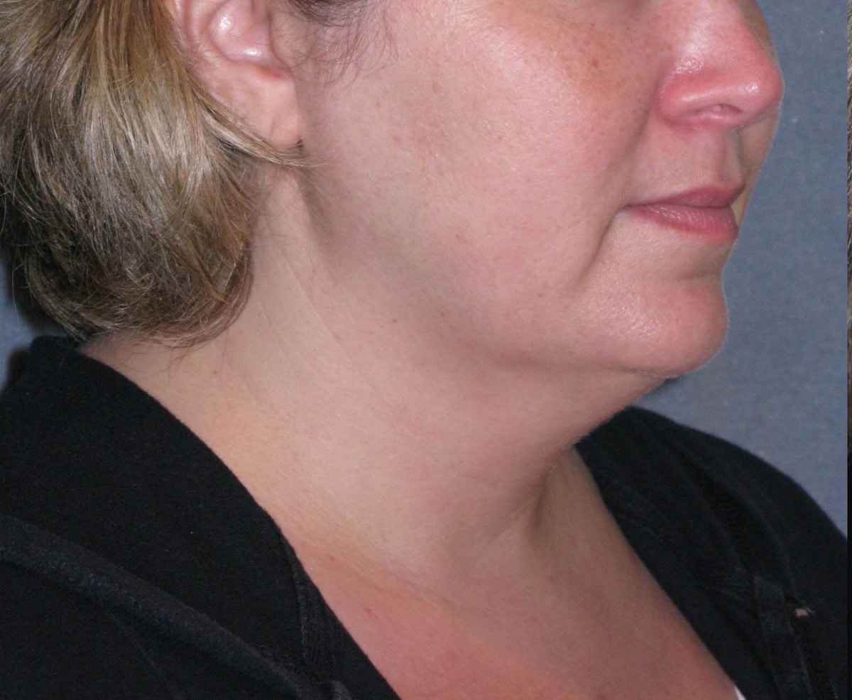 Lower Face & Neck Lifting Before & After Gallery - Patient 299080 - Image 5