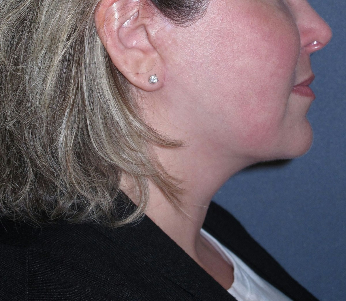 Lower Face & Neck Lifting Before & After Gallery - Patient 299080 - Image 8