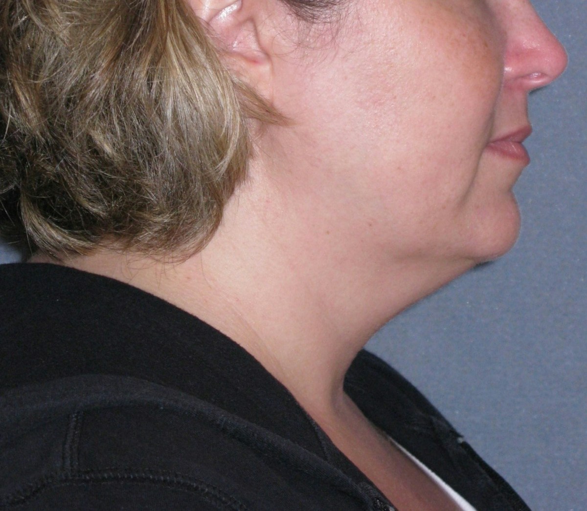 Lower Face & Neck Lifting Before & After Gallery - Patient 299080 - Image 7